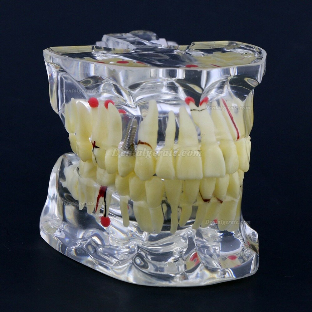 Neue Dental Teach-Studie Allgemeine Erwachsenenpathologie Typodont Z&auml;hne Modell # 4001